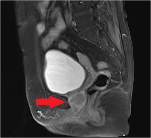 Sagittal T2-weighted MRI of the pelvis revealed a localized urethral tumor extended to vagina.