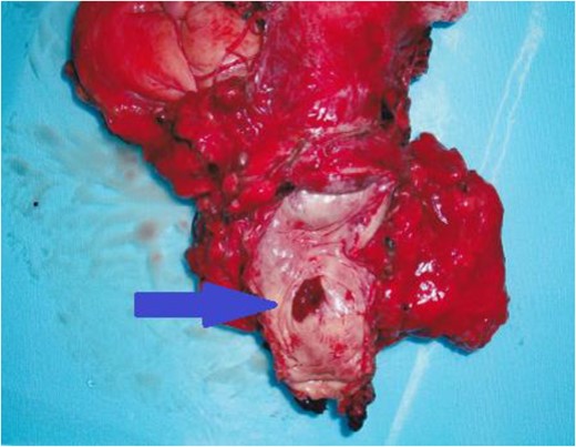 The resected specimen showed the mass on the anterior vaginal wall.
