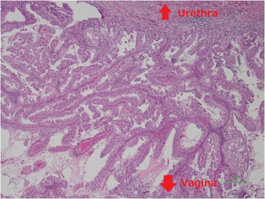 Histopathological examination of the specimen showed adenocarcinoma tumor which continues to anterior vaginal wall, but urethral diverticular wall could not be identified.