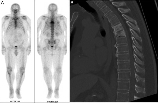 (A) Nuclear medicine bone scan demonstrating tracer uptake in the T5 and T6 vertebral fractures with no evidence of other abnormal uptake. (B) Mid-sagittal CT scan of the thoracic spine during clinical presentation with ataxia, displaying the vertebral crush fractures and SEL.