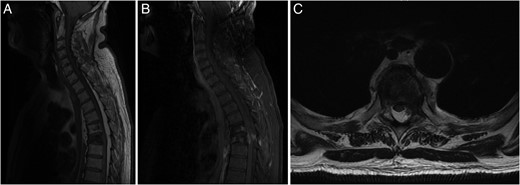 (A) Sagittal T1-weighted MRI showing the T5 and T6 vertebral compression fractures with extensive hyperintense SEL from C7 to T10. (B) Sagittal FAT SAT T1-weighted MRI following gadolinium contrast showing contrast enhancing paravertebral disease mainly at T6 level, with enhancing epidural disease with further canal stenosis from epidural lipomatosis. (C) Axial T2-weighted MRI displaying through T6 level showing compression and right lateral displacement of the thecal sac and spinal cord.