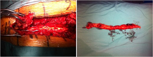 Intraoperative images displaying extensive epidural lipomatosis of the thoracic spine.