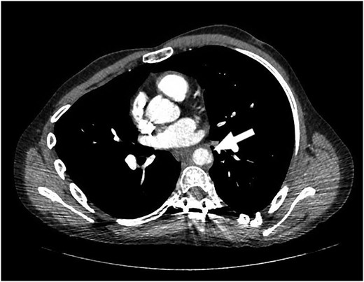 Arrow points to dissection in the descending aorta.