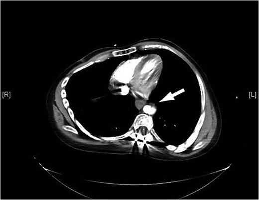 Arrow points to dissection in the descending aorta.