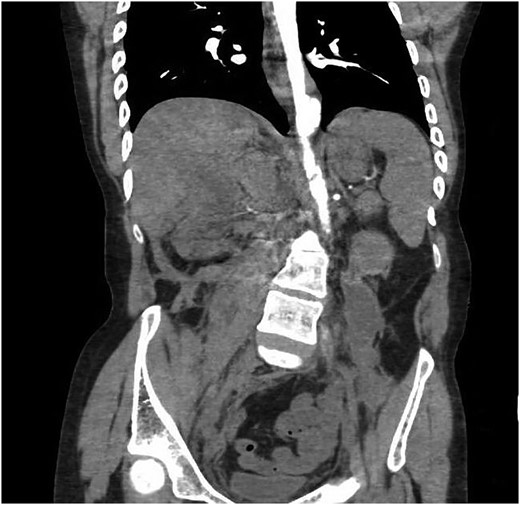 No contrast is seen in the abdominal viscera.