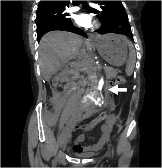 Note contrast in the distal aorta but no contrast in the iliac arteries.