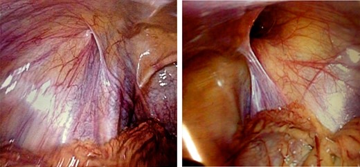 Closed left processus vaginalis and patent right processus vaginalis.