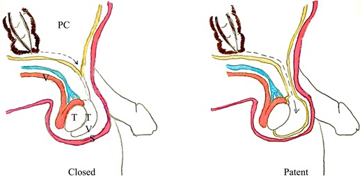 Tracking of pus down a closed and open processus vaginalis (PC, peritoneal cavity; V, vas deferens; T, testicle; TV, tunica vaginalis; S, scrotum).