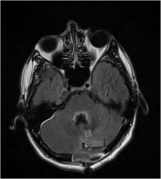 FLAIR MRI brain showing high signal abnormality in the floor of the fourth ventricle.