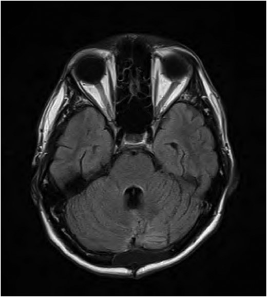 FLAIR MRI brain follow-up showing improvement of the signal abnormality in the fourth ventricle.
