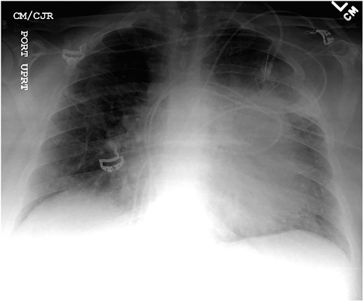 Anterior–posterior one view chest X-ray depicting enlarged cardiomediastinal silhouette with mild pulmonary edema.