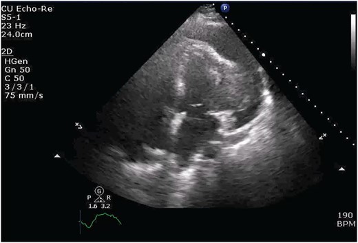 Transthoracic echocardiogram depicting large effusion within pericardial membrane with left ventricular mass.