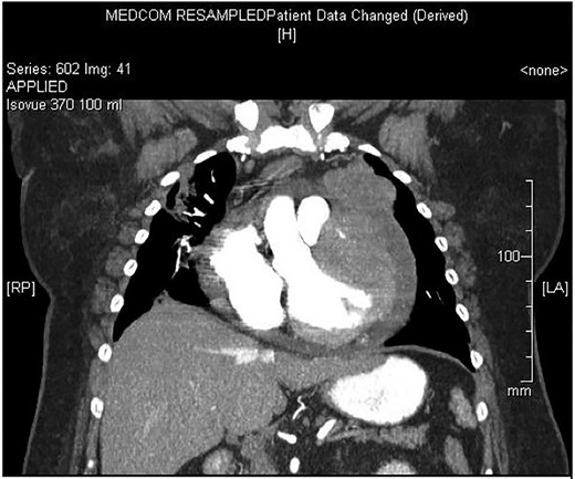 Large ventricular mass measuring 10.5 Ă— 7.5 Ă— 9.5 cm3 invading epicardium and myocardium.