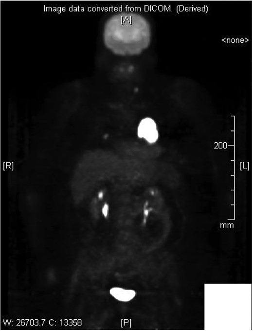 PET scan depicting increased uptake within cardiac region.