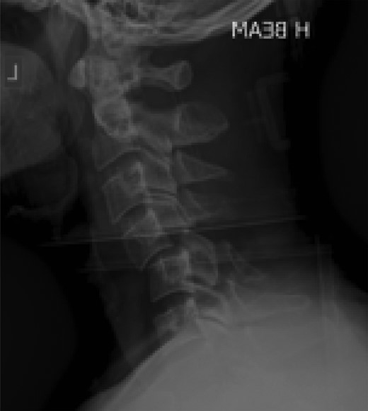 Lateral C-Spine radiograph showing bilateral C4/5 subluxation.
