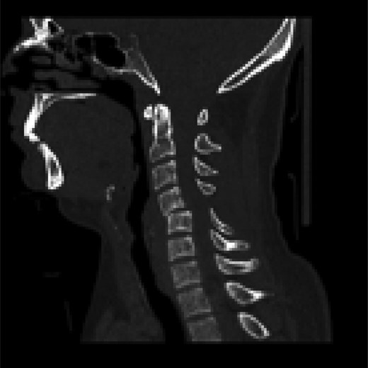Sagittal CT scan images showing a pure soft tissue bilateral C4/5 Subluxation with bilateral ‘Naked Facet’ sign.
