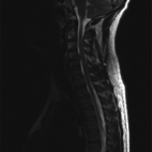 Sagittal T2-weighted MRI images showing a disc herniation at C4/5 and a non-contiguous disc extrusion at C/67 behind the vertebral body of C7.