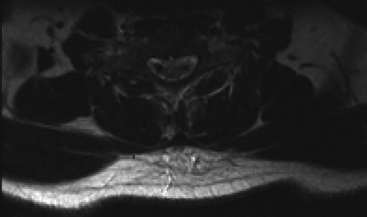 Axial T2 MRI image at C4/5 level showing central disc herniation.