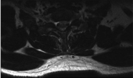 Axial T2 MRI image at C6/7 level showing central annular tear with left paracentral disc extrusion behind the C7 vertebral body.