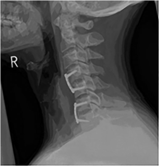 Lateral C-Spine radiograph showing realignment of C-Spine.