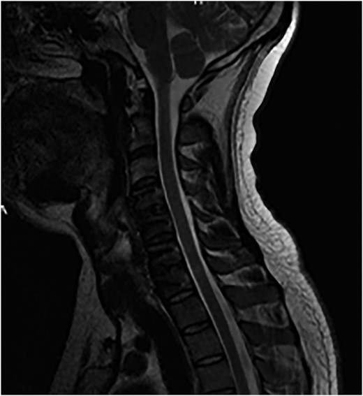 Sagittal T2-weighted MRI images showing decompression of the cord.