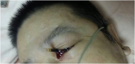 The ballpoint pen was firmly lodged in his left medial orbit between the globe and nose.