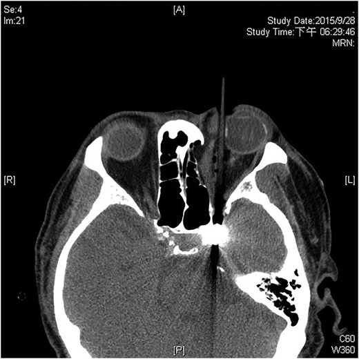CT scan shows the trajectory of the foreign body.