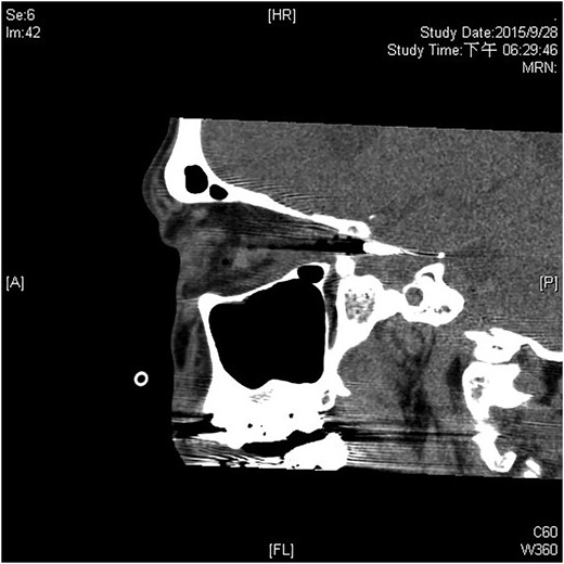 The ballpoint pen tip reaches into the parasellar region via the optic canal.