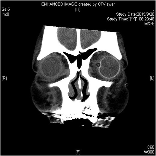 There was no evidence of a rupture in the globe.