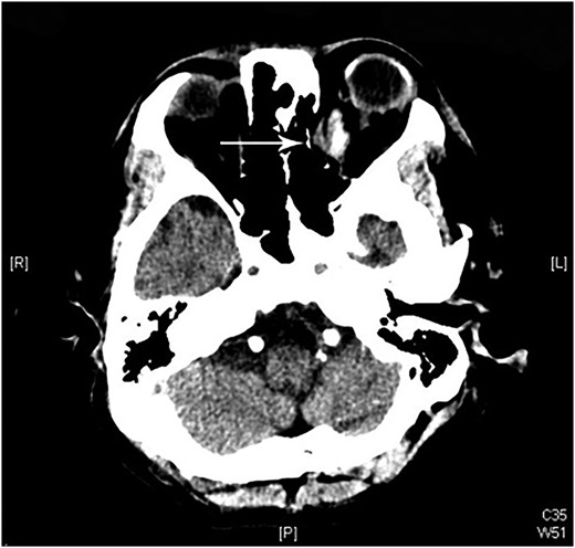 The follow-up CT scan shows residual hematoma in the orbital cavity; no retained foreign bodies or intracranial hemorrhaging.