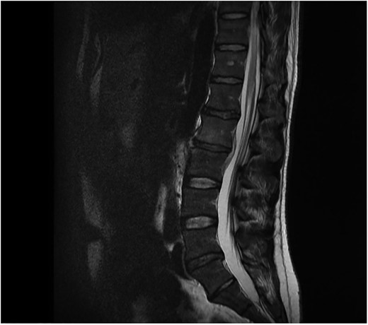 Sagital T1 MRI lumbosacral spine. Osteomyelitis in L2 and L3 vertebral bodies, epidural abscess and inflammation of the psoas muscles.