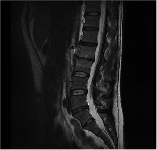 Sagital T1 MRI lumbosacral spine. 2 months later the epidural abscess has resolved and minimal marrow oedema is seen in L2 and L3 vertebra.