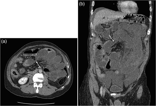 (a and b) Axial and coronal CT images showing obstruction of small bowel with transition point within Petersen's space (arrow).