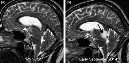 Comparative sagittal T2 imaging performed 2 years apart in demonstrating sagging of the brainstem with elongation of the midbrain and marked flattening of the pons surface. The scan from early September 2014 (b) demonstrates a new T2 hyperintense mass in the midbrain (arrow) compared with the earlier image (a).