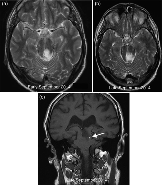 Comparative axial T2 images demonstrating growth of the midbrain mass between early (a) and late (b) September 2014. The coronal T1 image from September 2014 (c) reveals petechial haemorrhage (arrow) in the lesion with corresponding susceptibility artefact on gradient echo imaging (not shown).