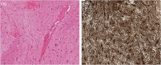 Grey matter parenchyma sample (a) consistent with brainstem biopsy showing prominent vessels and a small volume of haemorrhage. The GFAP stain (b) within the same sample confirms severe gliosis featuring spider-shaped reactive glia.