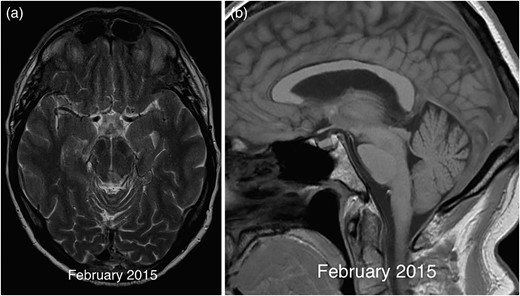 Axial T2 image in 2015 (a) demonstrating resolution of the midbrain mass except for a small biopsy scar. The corresponding sagittal T1 (b) image shows a mild improvement in the degree of brainstem sagging with less marked flattening of the pons compared with previous imaging.