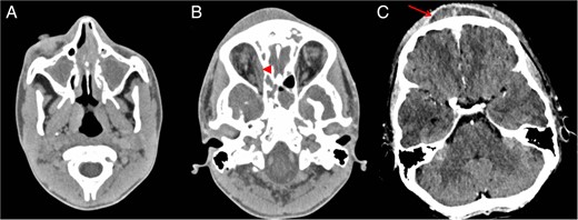 Post-contrast axial CT (A) shows opacified paranasal sinuses keeping with sinusitis. Right orbital subperiosteal abscess (arrowhead) and scalp subperiosteal abscess (arrow) consistent with Pott's puffy tumour seen on CT (B and C).