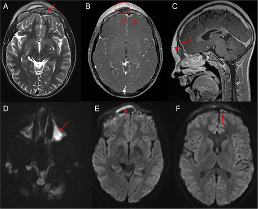 Post-drainage of right maxillary sinus and right orbital subperiosteal abscess MRI was performed. MRI shows abnormal signals (arrow) from the anterior frontal bone suggesting osteomyelitis (A). Post-contrast MRI demonstrates the scalp Pott's puffy tumour (circle) with surrounding scalp enhancement. MRI (B) also shows reactive dural enhancement and an epidural abscess that is better seen (arrowhead) on sagittal sequence (C) compressing the superior sagittal sinus (arrow) which is not thrombosed. Diffusion images (D–F) confirm pus in left maxillary sinus (D), scalp subperiosteal abscess (E) and intracranial extra-axial (F) epidural abscess (arrows).
