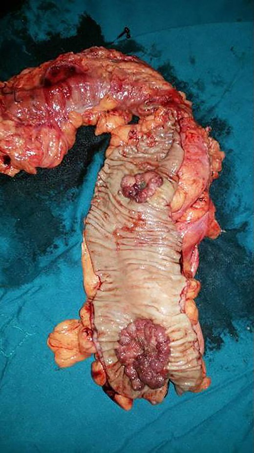 Resected segment of the colon showing two ulceroproliferative tumors. The proximal tumor in the descending colon turned out to be neuroendocrine cancer and the distal one in the sigmoid colon was adenocarcinoma.