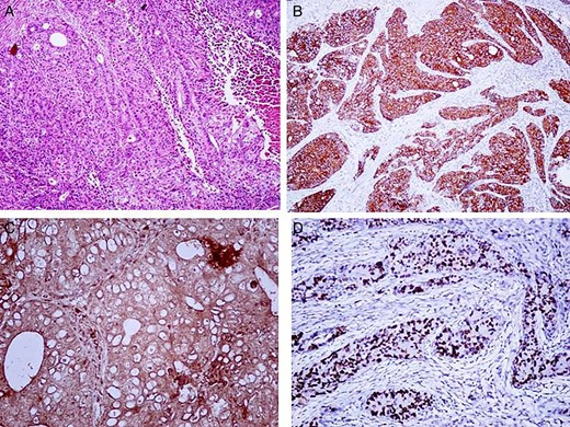 Microscopic appearance of the neuroendococrine carcinoma. (A) (H&E 20×) Showing round to polygonal tumor cells with pleomorphic nuclei, fine granular chromatin and prominent nucleoli arranged in diffuse sheets, insular pattern and variable organoid pattern. Immunohistochemistry showed that the tumor was (B) diffusely positive for synaptophysin and (C) NSE. (D) MIB-1 labeling index of the tumor was 75%.