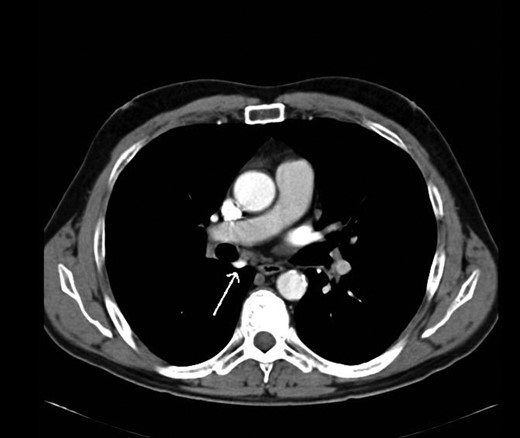 Axial view of CT thorax.