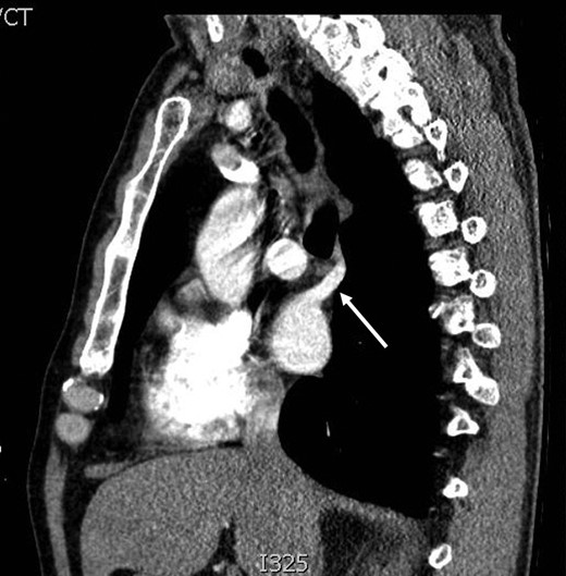 Sagittal view of CT thorax.