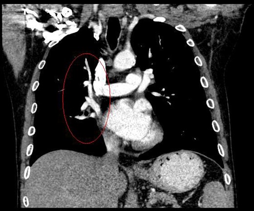 Coronal view of CT thorax.