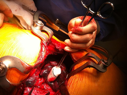 Intraoperative view.