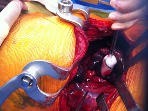 Intraoperative view.