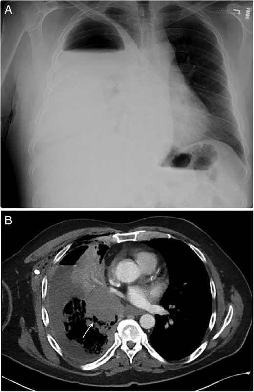 (A) Anterior–posterior chest X-ray showing large right-sided hydropneumothorax with mild right-to-left mediastinal shift. (B) Chest CT showing a right infrahilar mass (arrow) occluding bronchus intermedius with post-obstructive airspace disease within the right lower lobe.