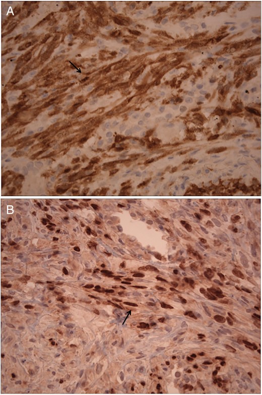 (A) 400× Histology of infiltrating melanocytes and diffuse desmoplasia within lung parenchyma and immunohistochemistry showing tumor cells staining positive for S100 (arrow). (B) 400× Histology demonstrating periarteriolar involvement, spindle cell formation and immunohistochemistry showing tumor cells stain positive with and nuclear SOX10 (arrow).