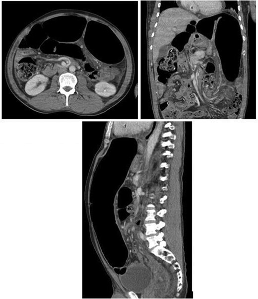 CT scan findings showing significant sigmoid colonic dilatation with concerns for sigmoid volvulus.