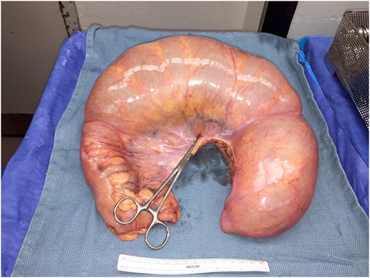 Colonic specimen following resection.